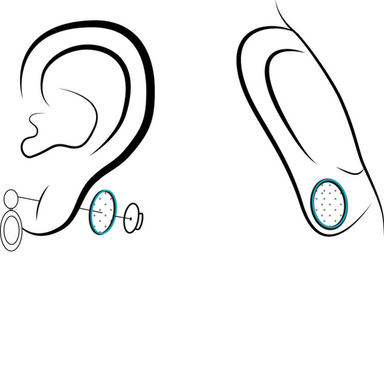 A simple, affordable fix for torn or stretched earlobes!